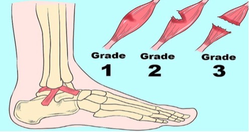 Sprained Ankle Treatment: What You Should Know - ISO Physio